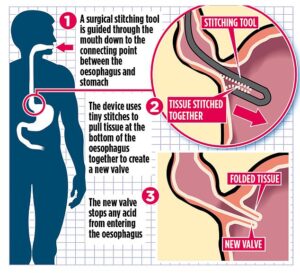 L'opération de 60 minutes, qui pourrait être disponible pour les patients du NHS dès l'année prochaine, comble les espaces entre l'œsophage et l'estomac - à travers lesquels les sucs d'estomac s'écoulent, provoquant la brûlure