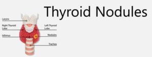 Nodules thyroïdiens: causes, symptômes et traitement