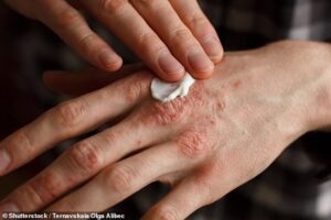 Des scientifiques ont mis au point un traitement improbable pour l'eczéma de la peau sèche - une crème contenant des bactéries de la peau humaine