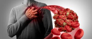 Caillots de sang : 8 signes d'alerte