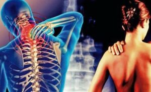 La cervicobrachialgie : cette douleur qui part du cou j...