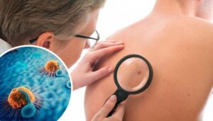 Les signaux d'alarme d'un cancer de la peau