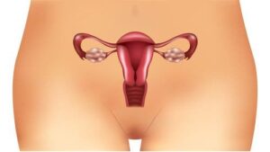 Les symptômes méconnus du syndrome des ovaires polykyst...