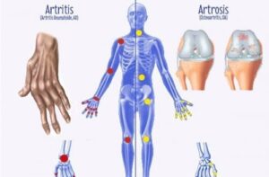 Quelques différences entre l'arthrose, l'arthrite et l'...