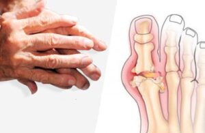 Recommandations pour soulager l'arthrite - Améliore ta ...