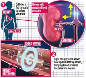 Comment un traitement impliquant une explosion sonique pourrait bénéficier jusqu'à 75 000 Britanniques souffrant d'hypertension artérielle