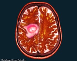 Le glioblastome est un cancer du cerveau qui entraîne des tumeurs sur le cerveau d'une personne.  Image : Une scintigraphie cérébrale montrant une tumeur de glioblastome