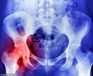 Seule la moitié des fiducies du NHS ont un service de liaison contre les fractures et beaucoup n'atteignent pas les objectifs, selon la Royal Osteoporosis Society