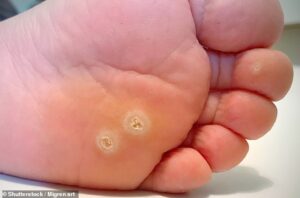 Les verrues (appelées verrues lorsqu'elles sont sur les pieds) sont causées par l'infection de la peau par un ou plusieurs membres de la famille des virus du papillome humain (VPH), dont il existe plus de 200 types [File photo]