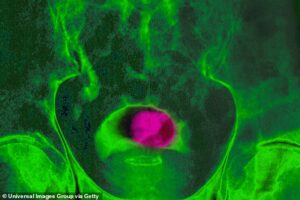 Des chercheurs du Royal Marsden NHS Foundation Trust et de l'Institute of Cancer Research ont découvert que la quantité habituelle de rayonnement pour traiter le cancer de la prostate - délivrée à petites doses sur environ 20 séances par mois - peut être administrée en toute sécurité en seulement cinq grandes doses sur sept à 14 jours.  (Ci-dessus, scintigraphie pelvienne d'une tumeur de la prostate)