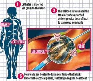 Au cours du nouveau traitement, appelé ablation par ballonnet par radiofréquence, un ballonnet muni de dix électrodes est inséré dans une artère de l'aine et enfilé jusqu'aux veines pulmonaires.