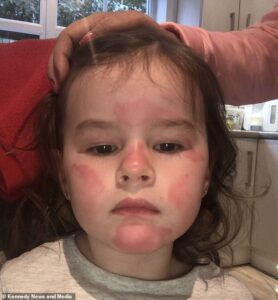 La fille de trois ans de Lezah Thompson, Lezah, a subi des brûlures et des rougeurs au visage pendant 24 heures après avoir utilisé la propre marque de lotion pour bébé de Lidl.