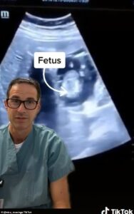 Les médecins ont identifié une grossesse extra-utérine dans le foie d'une femme.  Sur la photo: le Dr Michael Narvey partage le cas sur TikTok, montrant une échographie du fœtus incrustée dans le foie