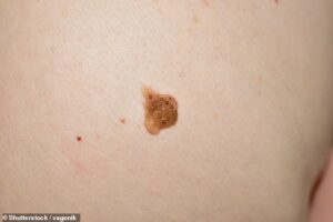 Le grain de beauté était un mélanome malin - la forme la plus dangereuse de cancer de la peau, qui peut se propager rapidement ailleurs dans le corps et faire plus de 2 000 morts chaque année au Royaume-Uni [File photo]