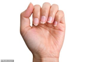 Chez la plupart des gens, les dommages aux ongles (parfois aux ongles des pieds) font suite à ces symptômes, car l'inflammation de la peau du lit de l'ongle perturbe la croissance des ongles