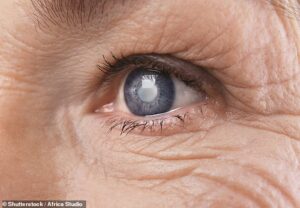 Les cataractes sont des taches nuageuses sur le cristallin de l'œil, qui se développent généralement à la suite du vieillissement.  Ils s'aggravent généralement avec le temps et la chirurgie est le seul moyen pour les personnes atteintes d'améliorer leur vue (stock)