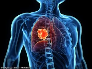 Des milliers d'autres patients du NHS atteints d'un type mortel de cancer du poumon doivent bénéficier d'un médicament salué comme la plus grande percée thérapeutique depuis des décennies (stock photo)