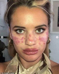Aie!  Tilly Whitfeld, 22 ans, de Northern Beaches à Sydney, a été laissée définitivement cicatrisée et temporairement aveugle d'un œil après s'être fait tatouer des taches de rousseur sur le visage.