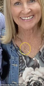 Jillian Murray, 62 ans, de Cairns, Australie, photographiée avec la marque qui s'est avérée être un cancer de la peau