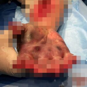 Un toxicomane et alcoolique s'est fait amputer les cinq doigts de la main droite après s'être injecté trois comprimés de morphine écrasés.  Sur la photo ci-dessus, la main après l'injection