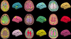 Une équipe de l'University College de Londres a développé un algorithme qui détecte la dysplasie corticale focale (FCD) résistante aux médicaments, une anomalie subtile du cerveau qui provoque l'épilepsie.  Sur la photo: anomalies cérébrales identifiées par l'algorithme (surlignées en vert citron) sur les IRM d'enfants et d'adultes épileptiques du monde entier