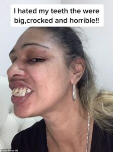 Leona Clarke, 41 ans, a été victime d'intimidation pour ses «dents de cheval» à l'école.  La mère photographiée avant de se faire réparer les dents