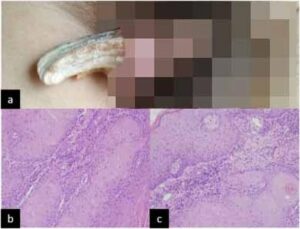 L'homme non identifié de 43 ans a demandé conseil à des urologues à Taiyuan, dans le nord-est de la Chine, trois ans après sa première apparition.  Malgré la croissance «dure», «brun jaunâtre» commençant aussi petite qu'un grain de riz, elle a poussé de 5,5 cm sur 3 cm (2 pouces sur 1 pouce) avant l'intervention des médecins (photo, en haut).  L'analyse des tissus a montré que l'homme avait un carcinome épidermoïde - la deuxième forme la plus courante de cancer de la peau (photo, en bas)