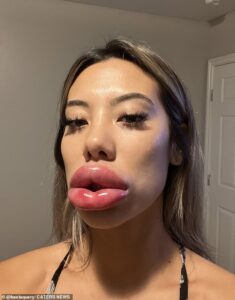 Basia Query, 24 ans, de Las Vegas, Nevada, a vu ses lèvres gonfler jusqu'à trois fois leur taille normale, la laissant craindre qu'elles ne soient coupées après avoir eu une réaction allergique aux charges.