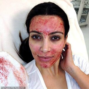 Kim Kardashian, sur la photo, a subi un traitement facial de vampire qui consiste à réinjecter le sang d'un patient dans sa peau