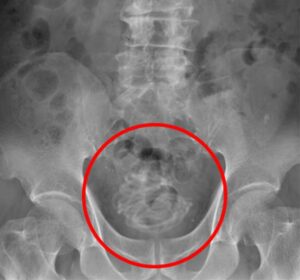Cette radiographie a révélé l'objet de l'inconfort urinaire de l'homme de 79 ans, une corde à sauter étroitement enroulée et maintenant emmêlée qu'il avait insérée dans son pénis.