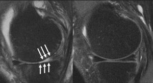 L'image ci-dessus montre l'articulation du genou d'un patient souffrant d'arthrite (à gauche), les flèches indiquant où le cartilage a été usé.  L'autre (à droite) montre un patient qui n'a pas d'arthrite