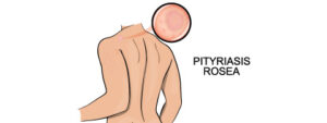 Pityriasis rosé : causes, symptômes et traitement