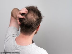 La perte de cheveux affecte environ 80 millions d'hommes et de femmes aux États-Unis chaque année.  Les hommes ont plus de chances de devenir chauves que les femmes, et le risque augmente avec l'âge.  Environ 30 à 50 % des hommes souffriront de calvitie masculine à l'âge de 50 ans